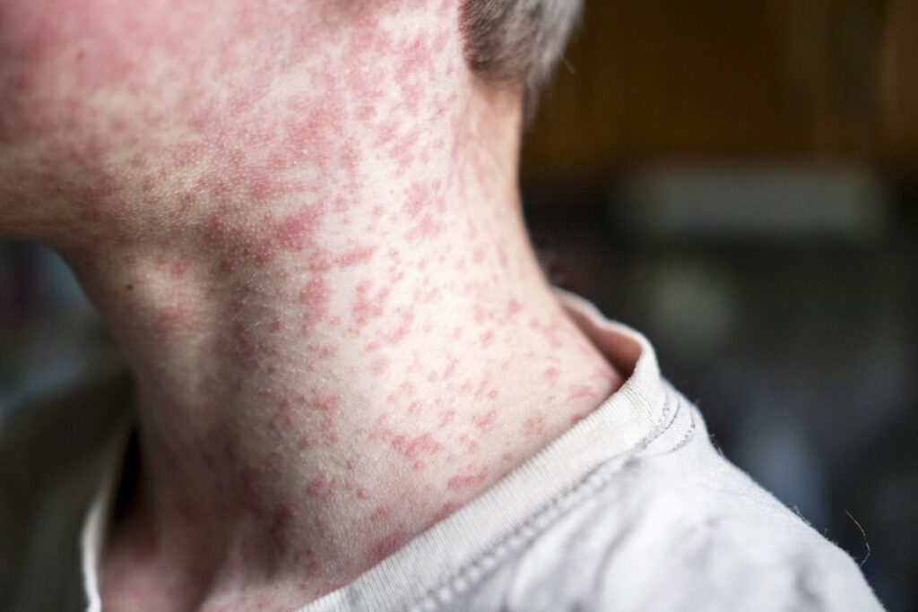 Measles rash