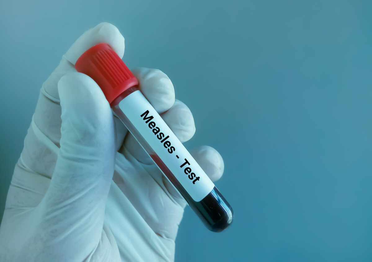 Measles test
